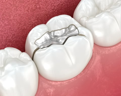 Cracked tooth with amalgam, splitted. Dental 3D illustration