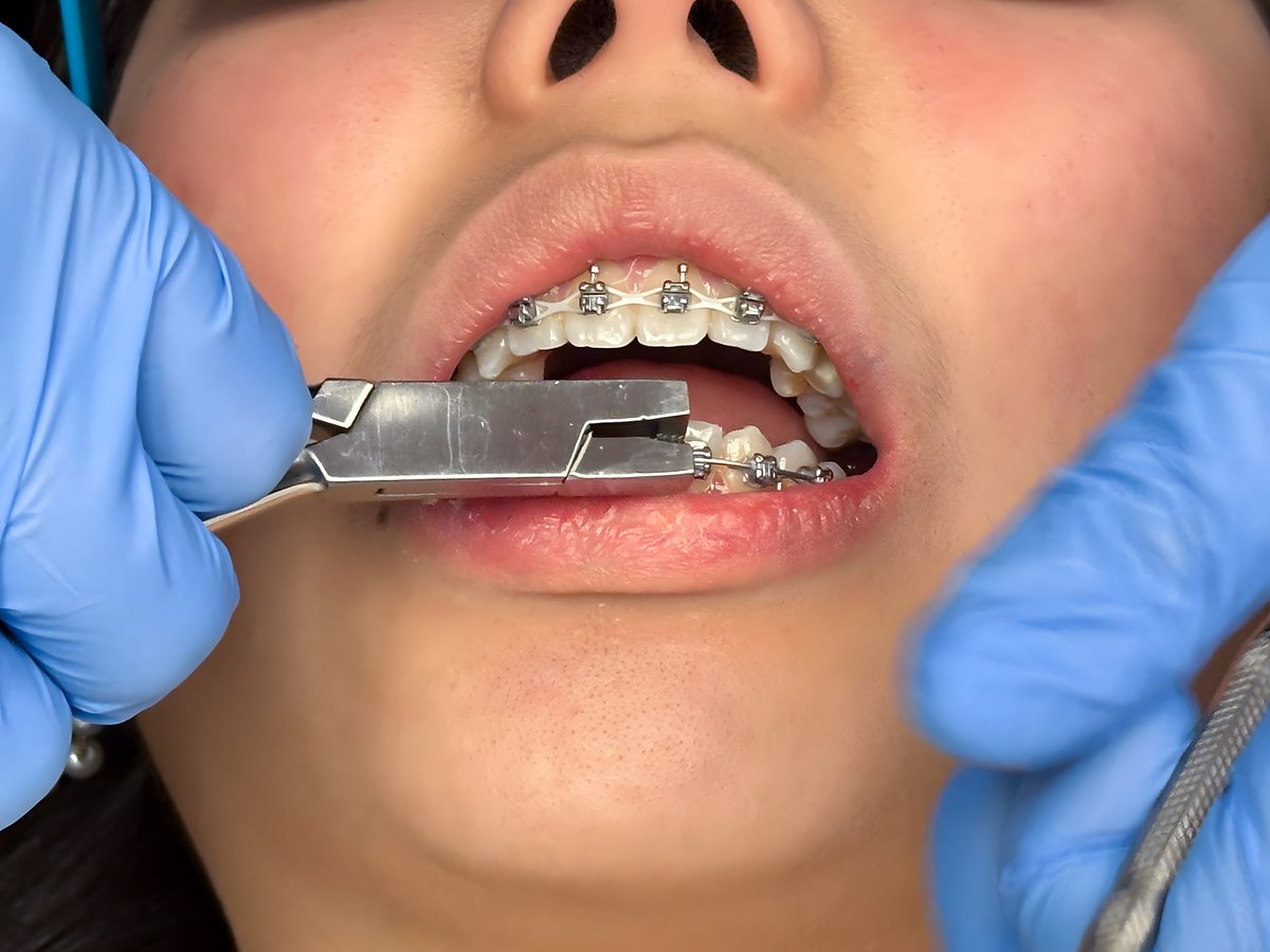 Orthodontist installing LightForce custom braces on patient teeth at Smart Smile Orthodontics