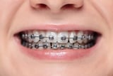 Braces