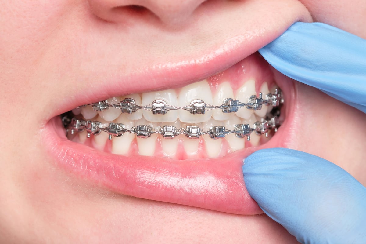Close-up of a dentist's gloved hand examining patient's teeth with metal bracket system